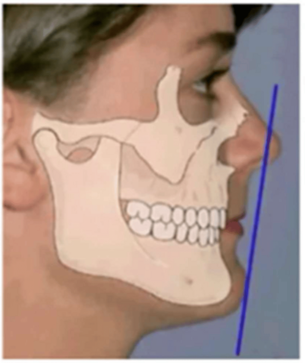 <p>What is the lip posture described as?</p>