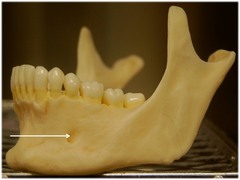 <p>a part of the mandible</p>