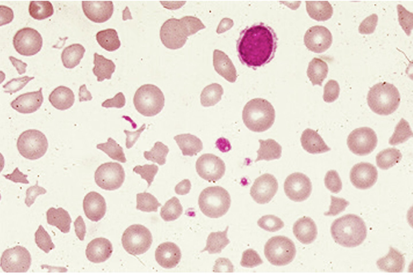 <p>Fragmented cells seen with DIC, TTP, Heart valves hemolysis, and severe burns</p>