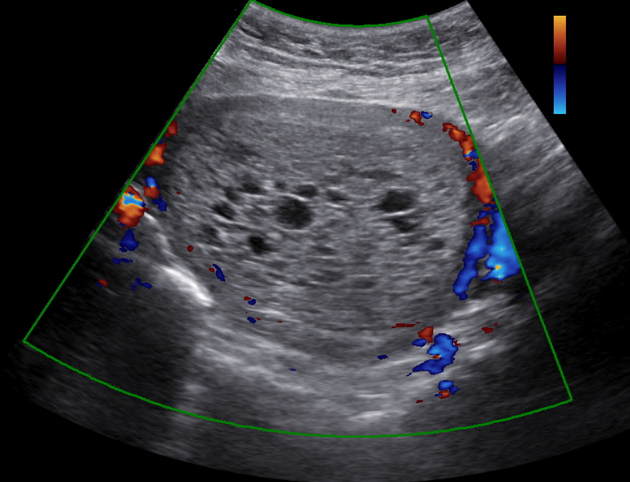 <p><br><span>Tiny grape like clusters within the endometrium is...</span></p>