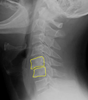 <p>Facets - Bilateral Locks</p>