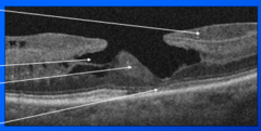 <p>-Irregular foveal contour</p><p>-Lamellar hole-associated epiretinal proliferation (LHEP) 1</p><p>-Foveal cavitation and loss of foveal tissue 2</p><p>-Foveal bump 3</p><p>-Ellipsoid zone disruption 4</p><p>Top to bottom 1-4</p>