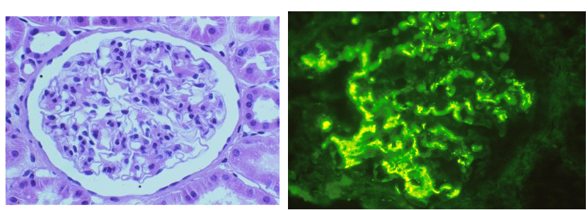 <ul><li><p>IgA nephropathy (Berger’s Disease)</p><ul><li><p>IgA is most commonly found in mucous membranes</p></li><li><p>nephropathy = pathology of the kidney</p></li><li><p>most common form of adult glomerulonephritis (inflammation of the glomerulus)</p><ul><li><p>IgA clumps together and causes backup in glomerulus</p></li></ul></li></ul></li></ul><p></p>