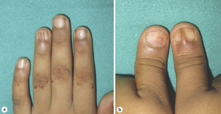 <p>what nail condition is this?</p>