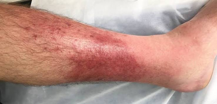<p>An acute, spreading bacterial infection of the deep layers of the skin and subcutaneous tissue.</p>