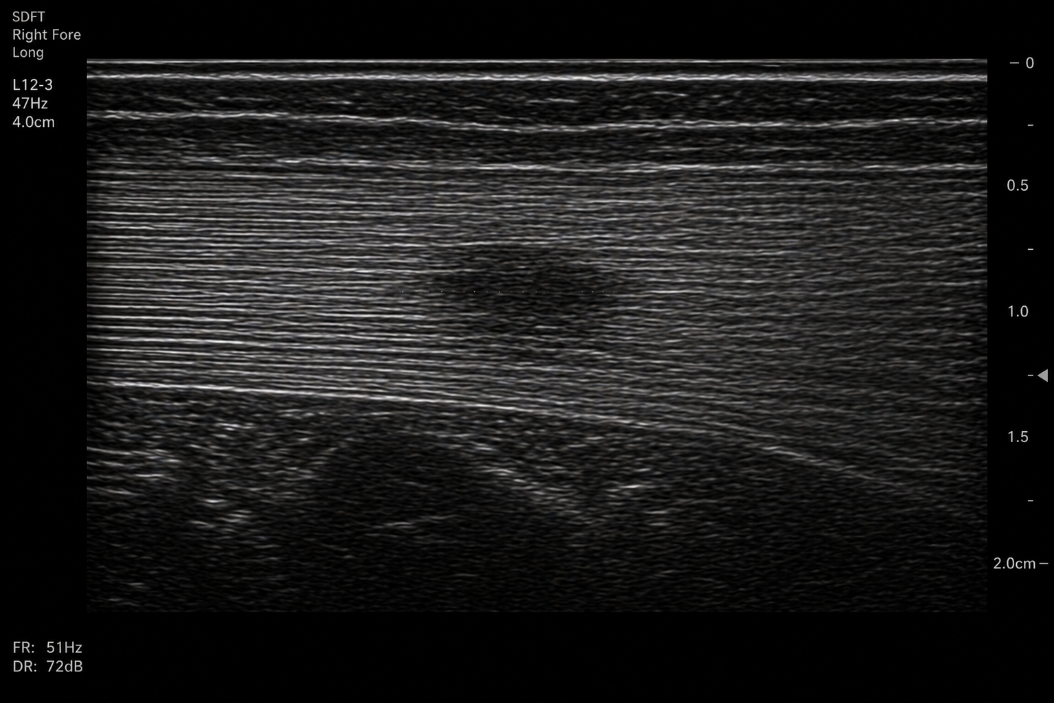 <p>High Voltage presents with acute right forelimb lameness and marked swelling of the palmar metacarpal region following exercise. Palpation reveals heat and pain over the superficial digital flexor tendon (SDFT).</p><p>Context: bone creates acoustic shadowing on ultrasound — the large impedance mismatch at a bone surface causes near-total reflection of the sound beam, preventing visualization of structures deep to bone. This means ultrasound cannot evaluate structures behind cortical bone. Ultrasound can, however, evaluate soft tissue structures accessible from the skin surface with no intervening bone.</p><p>Ultrasound of the SDFT is performed using a linear high-frequency transducer in longitudinal orientation.</p><p>The image shows the SDFT as a parallel fibrillar echotexture (multiple bright parallel lines representing the organized collagen fiber bundles). A focal region of decreased echogenicity (hypoechoic) is visible within the tendon substance, disrupting the normal fibrillar pattern.</p><p>A colleague reviewing the images comments: "I see the lesion — but I notice the fiber alignment looks different in the right quadrant of the image. Is that part of the injury or something else?"</p><p>Ultrasound equine: Right forelimb, SDFT Longitudinal</p><p></p><p><strong>Which explanation best accounts for the difference in echogenicity between the bright diaphragm–lung boundary and the comparatively weaker fluid–liver boundary on ultrasound?</strong></p><p><span>a. Ultrasound is appropriate because the SDFT is a superficial soft tissue structure with organized fibrillar architecture — each collagen interface produces echoes detectable by the transducer. The altered fibrillar appearance in the right quadrant most likely represents anisotropy: a probe angle artifact that occurs when the beam strikes the tendon at a non-perpendicular angle, reducing echo return from the fibers and making them appear hypoechoic.</span></p><p><span>b. Ultrasound is appropriate because tendons contain a high proportion of water, making them anechoic on ultrasound and easy to identify. The altered appearance in the right quadrant represents hemorrhage within the tendon sheath, which appears hypoechoic because blood products reduce sound transmission.</span></p><p><span>c. Ultrasound is appropriate because MRI and radiography cannot image soft tissue structures at all. The altered appearance in the right quadrant represents a second separate tendon lesion that the referring veterinarian missed on physical examination.</span></p><p><span>d. The diaphragm–lung boundary is strongly hyperechoic because aerated lung and soft tissue have a large acoustic impedance mismatch, causing strong reflection of ultrasound waves. In contrast, the fluid–liver boundary produces weaker reflections because fluid and liver tissue have more similar acoustic impedances, resulting in a lower reflection coefficient and less echogenic interface.</span></p><p></p>