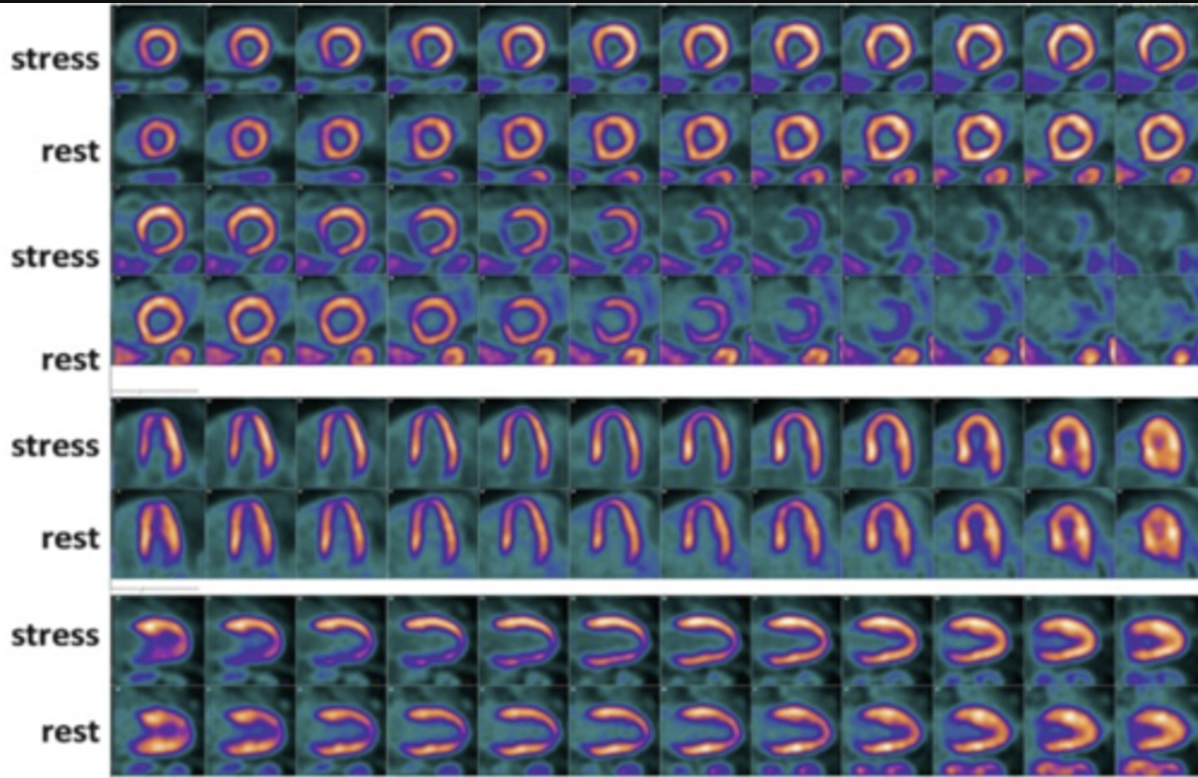 <p>The image below best demonstrates</p><p>a. A normal myocardial perfusion study</p><p>b. a narrowed left anterior descending artery</p><p>c. a narrowed right coronary artery</p><p>d. a 100% occluded / blocked left anterior descending artery</p>