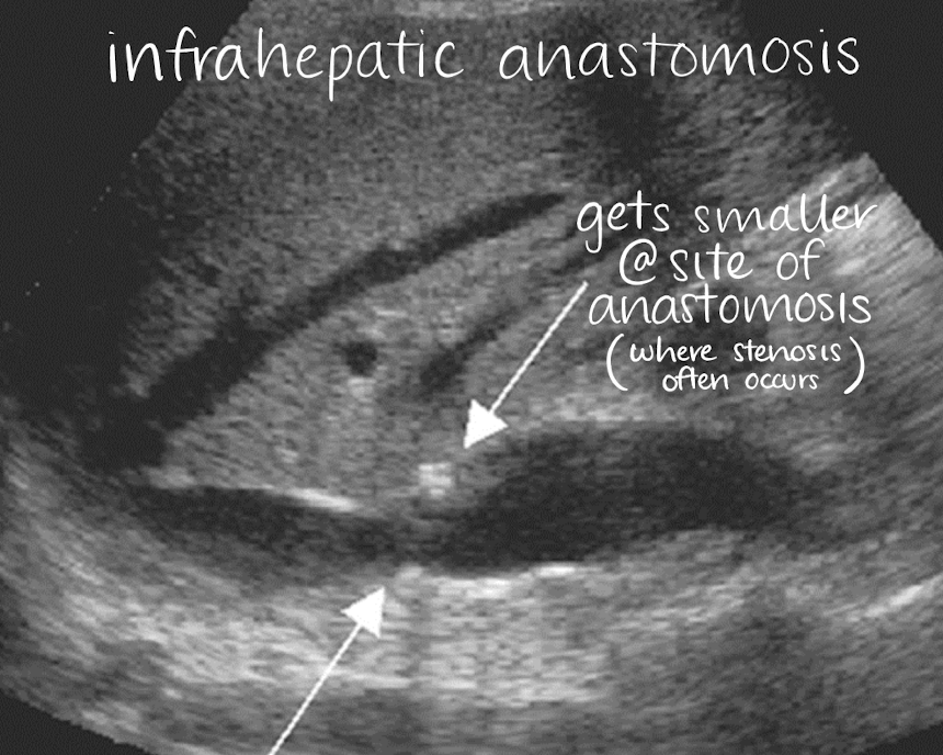 <p>infrahepatic anastomosis (below HV)</p>