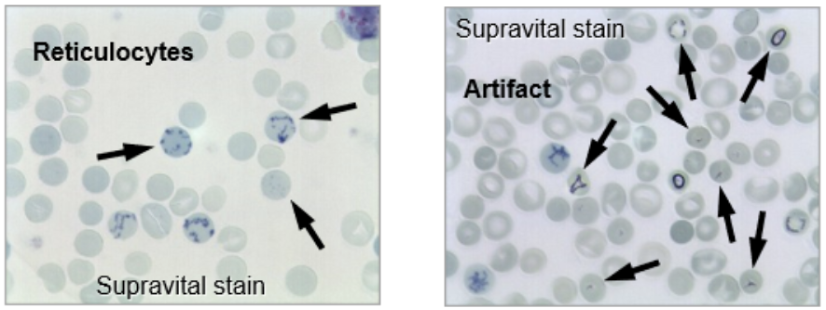 <p><span style="background-color: transparent;"><strong>Procedure and principle of supravital stains</strong></span></p><ul><li><p><span style="background-color: transparent;"><u>Principle</u>: supravital stains are used to count retics. </span></p></li></ul><ul><li><p><span style="background-color: transparent;">Supravital “living cell” stain → NEW methylene blue</span></p></li><li><p><span style="background-color: transparent;">Precipitates RNA into filaments or granules</span></p></li></ul><ul><li><p><span style="background-color: transparent;">2 blue “dots” or more is a retic</span></p></li></ul><ul><li><p><span style="background-color: transparent;">Don’t count red cells with black/shiny inclusions</span></p></li></ul><ul><li><p><span style="background-color: transparent;">Using Oil Immersion, count 500 red cells in area of slide where red cells just touch</span></p></li></ul><ul><li><p><span style="background-color: transparent;">Separate mature RBCs vs retics using 2 keys</span></p></li><li><p><span style="background-color: transparent;">retics/500 RBCs must agree +/- 2 retics on 2 different slides or another slide is counted</span></p></li></ul><p><span style="background-color: transparent;"><strong><u>Sources of error</u></strong></span></p><ul><li><p><span style="background-color: transparent;">Absolute # is more reliable than relative %</span></p></li><li><p><span style="background-color: transparent;">Improper blood to stain ratio or inadequate mixing</span></p></li><li><p><span style="background-color: transparent;">Improper counting → counting artifact or not counting red cells with 2 “dots” as retics</span></p></li><li><p><span style="background-color: transparent;">Wrong calculation → especially absolute</span></p></li></ul><p><span style="background-color: transparent;"><strong><u>Normal reference values expressed in both relative and absolute numbers</u></strong></span></p><ul><li><p><span style="background-color: transparent;">Adult: </span></p></li></ul><ul><li><p><span style="background-color: transparent;">0.5 - 2.0%</span></p></li></ul><ul><li><p><span style="background-color: transparent;">25-100,000/cmm Absolute #</span></p></li></ul><ul><li><p><span style="background-color: transparent;">Newborn</span></p></li></ul><ul><li><p><span style="background-color: transparent;">2.0 - 6.0%</span></p></li></ul><p></p>
