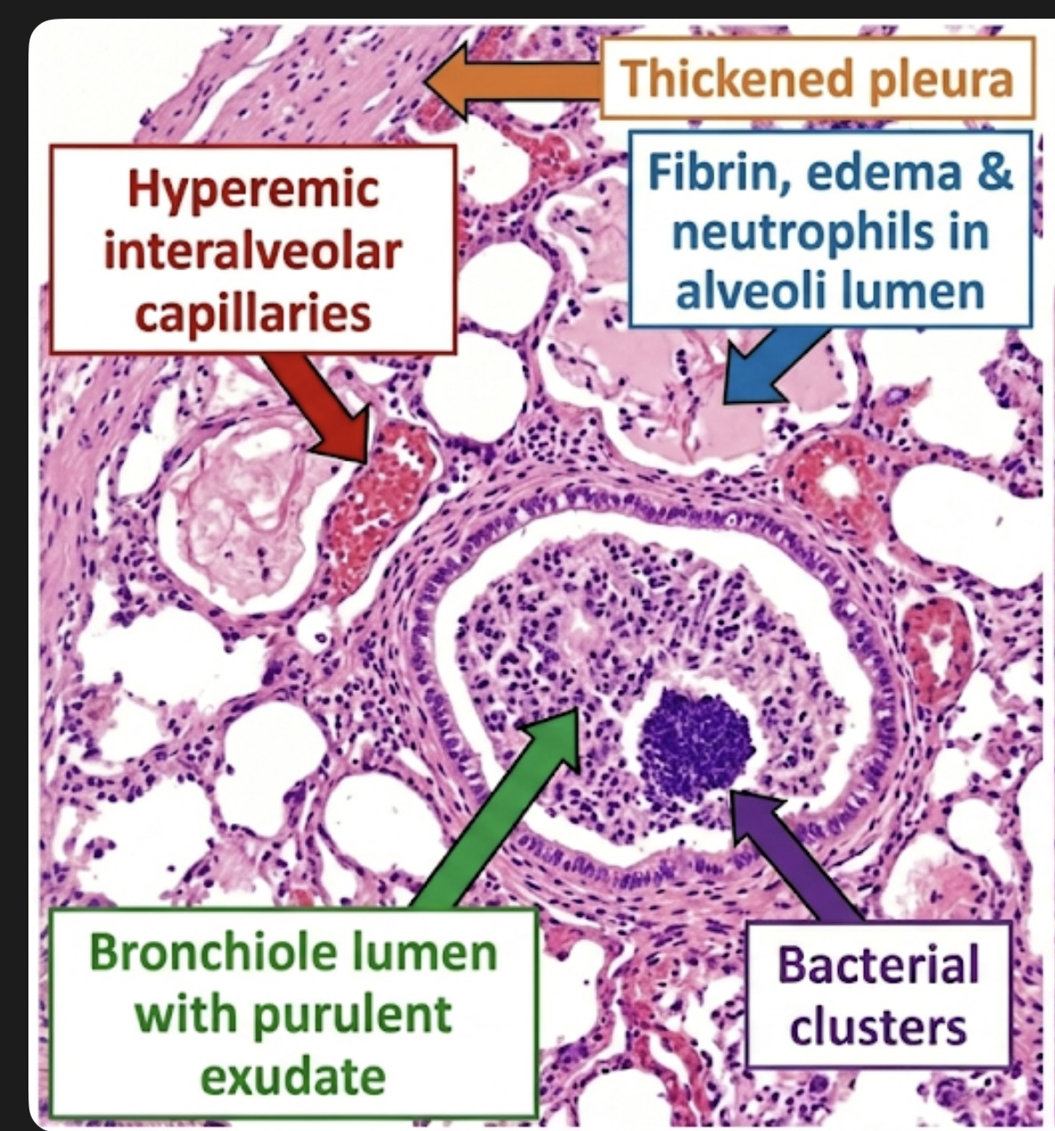 <p>bronchopneumonia fibrinosa, contagious caprine pleuropneumonia, lung</p>