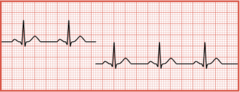 <p>A baseline that is not continuous sometimes indicates an interruption in the electrical connection</p>