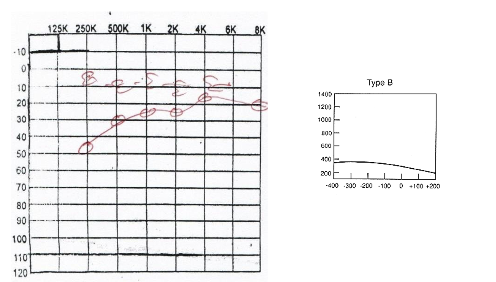 <p>Mild Conductive loss </p><p>Flat Tymp</p><p>Large ECV</p>