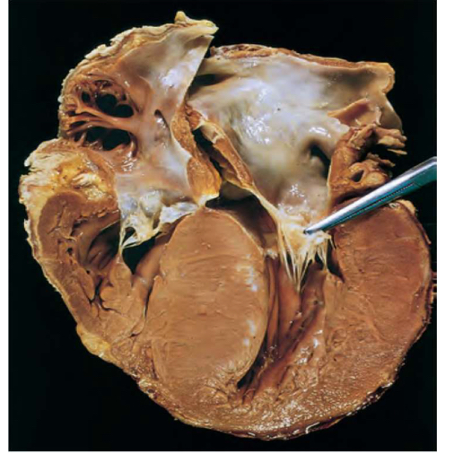 <p>Type of cardiomyopathy?</p>