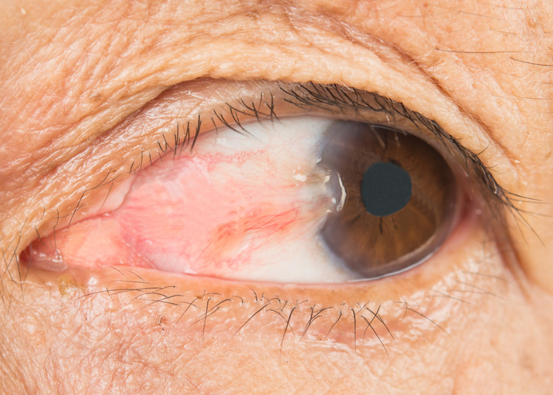<p>PP: fibrovascular tissue from conjunctiva→cornea→dry eye/astigmatism</p><p>E: UV exposure<br>chronic irritation</p><p>CM: wing-shaped fold on eye</p>