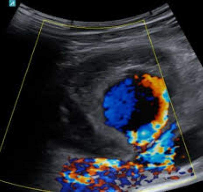 <p>pseudoaneurysm</p>
