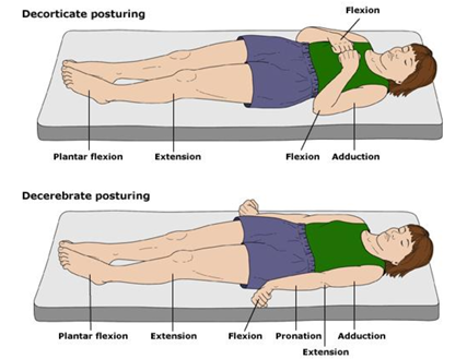 <p>Decorticate → PF, leg extension, arms tucked into chest</p><p>Decerebrate → PF, leg extension, arm extension, wrist flexion </p>