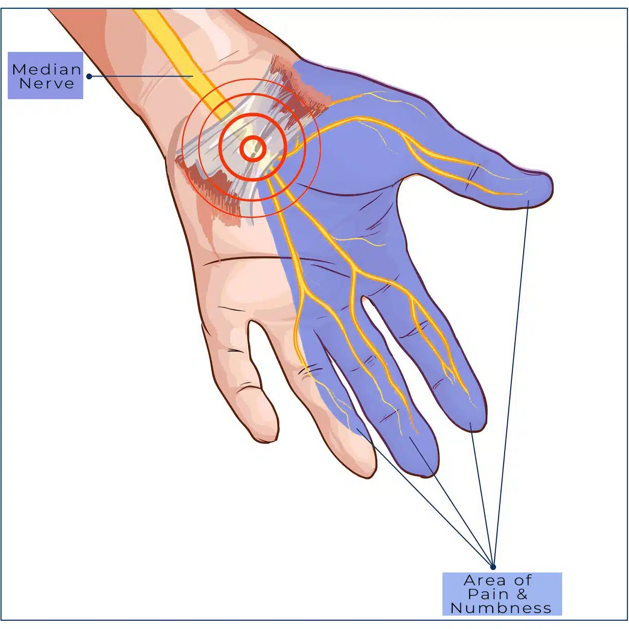 <p>What is carpal tunnel syndrome?</p>