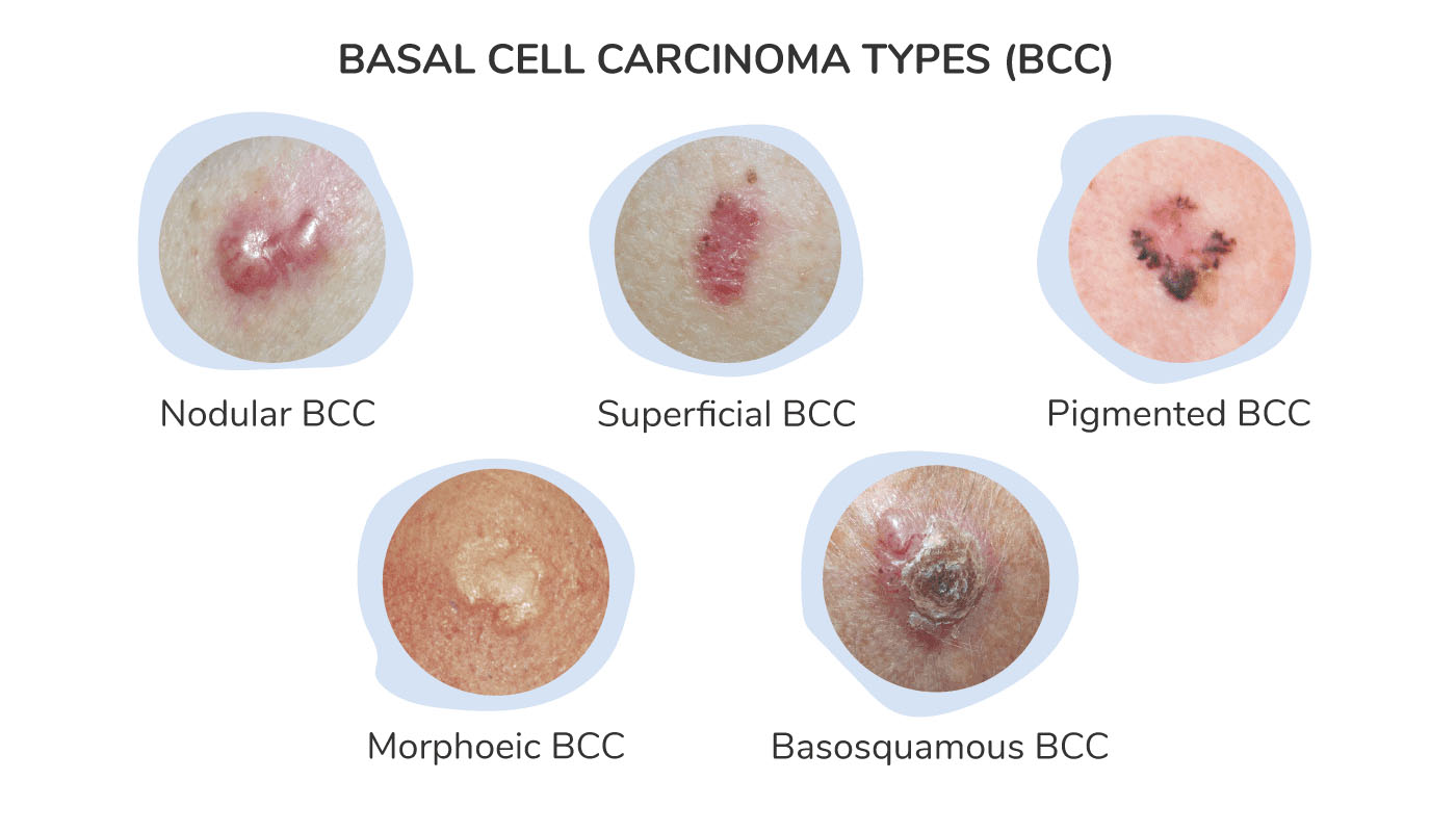 <p>The most common type of skin cancer, arising from basal cells. It often appears as a pearly bump or “pimple” that does not heal and may crust or bleed.</p>