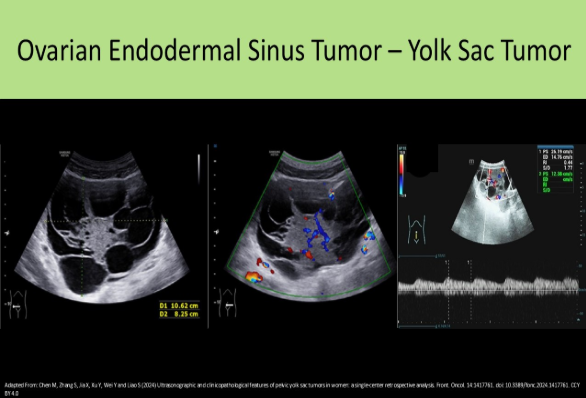 <p>D. yolk sac tumor</p><p>Endodermal Sinus Tumor AKA yolk sac tumor, is highly malignant. They usually present in adolescence and cause increased AFP levels in the blood. The other choices are related to elevated CA125 levels.</p>