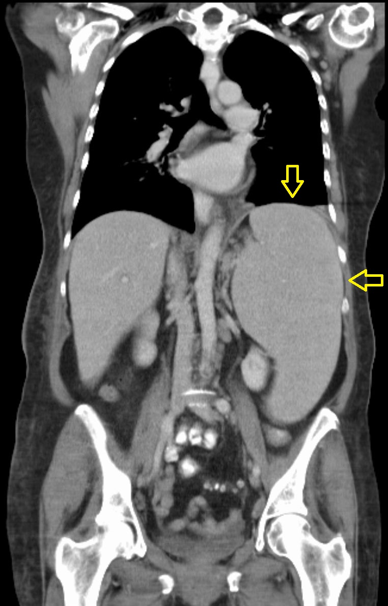<p>SPLENOMEGALY</p>