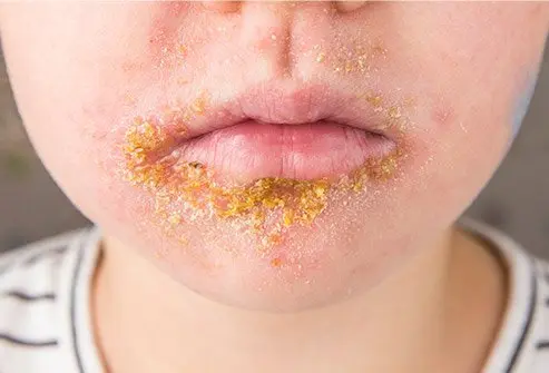 <p>Impetigo</p>