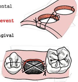 <p>a <span style="color: red;">modification of the horizontal mattress suture</span> technique</p><p>used<span style="color: red;"> to close open sockets</span> and <span style="color: red;">prevent clot displacement</span></p><p>provides<span style="color: red;"> good adaptation of gingival papilla</span> along the adjacent teeth</p>