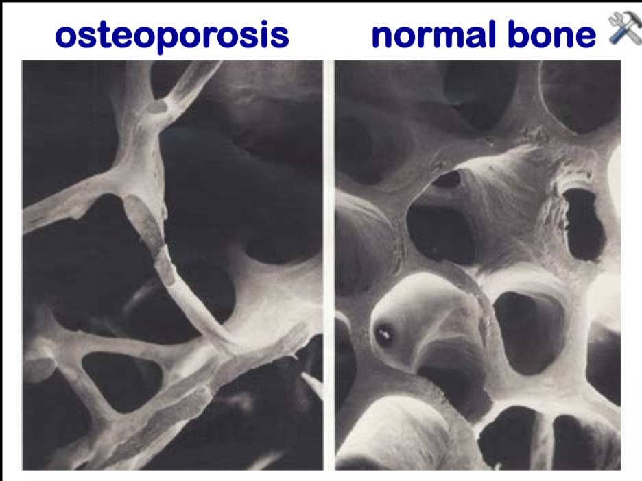 <p>Osteomalacia — organic bone matrix normal, but not calcified matrix > calcium</p><p>Osteoporosis — matrix/calcium ratio normal, both reduced. Thin and brittle bones. </p>