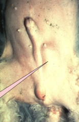 <p>What are tumors in the retained testis/cryptorchidism like?</p>