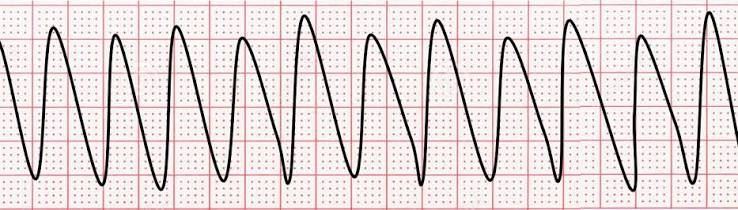 <p>this is what dysrhythmia</p>