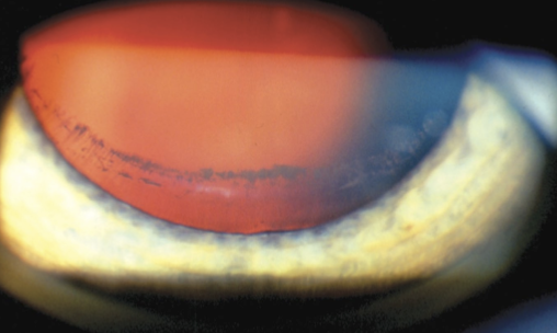 <p>Zentmayer line is pigment deposition on the zonules or peripheral anterior lens surface.</p>