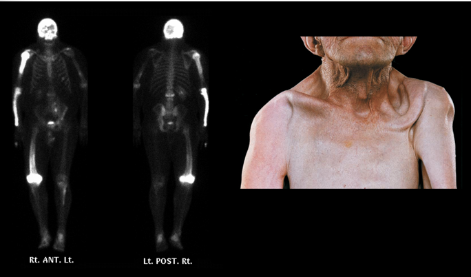<p>increased bone remodeling with excessive bone <strong>resorption</strong> and <strong>formation</strong>.</p><ul><li><p>single or several bones</p></li><li><p>INITIALLY = NO S/S</p></li><li><p>rare = develop into a lesion (osteosarcoma)</p></li></ul><p></p>