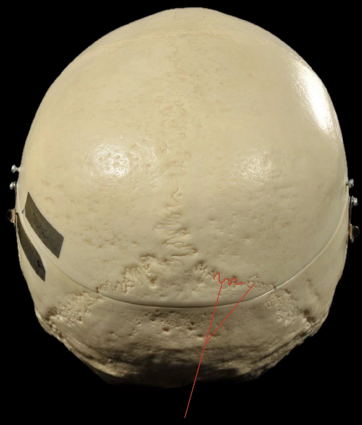 <p>What suture is this?</p>