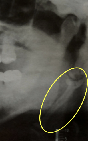 <p>elongation of styloid process or mineralization of the stylohyoid ligament; pain during opening, swallowing, turning head sideways; usually bilateral </p>