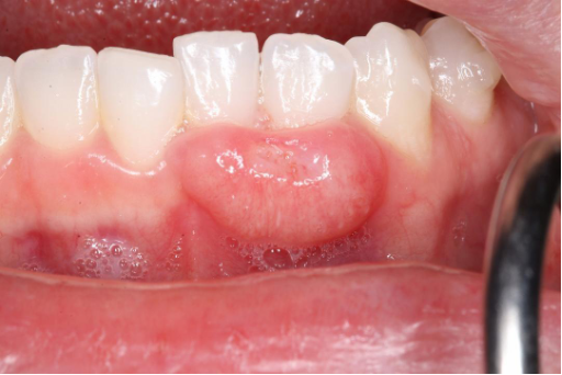 <p>CASE: An older woman with little to no tobacco history has a persistent irregular gingival mass/ulcer that has not responded to routine dental care. Which malignancy should remain high on the differential despite the absent smoking history?</p>