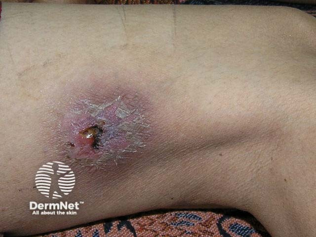 <p>Melioidosis (Pseudoglanders)</p><p></p><p>PS: because it looks and acts almost exactly like an ancient, highly contagious veterinary disease called <strong>glanders</strong>, but it is caused by a different, "pseudo" (false) version of the bacteria</p>