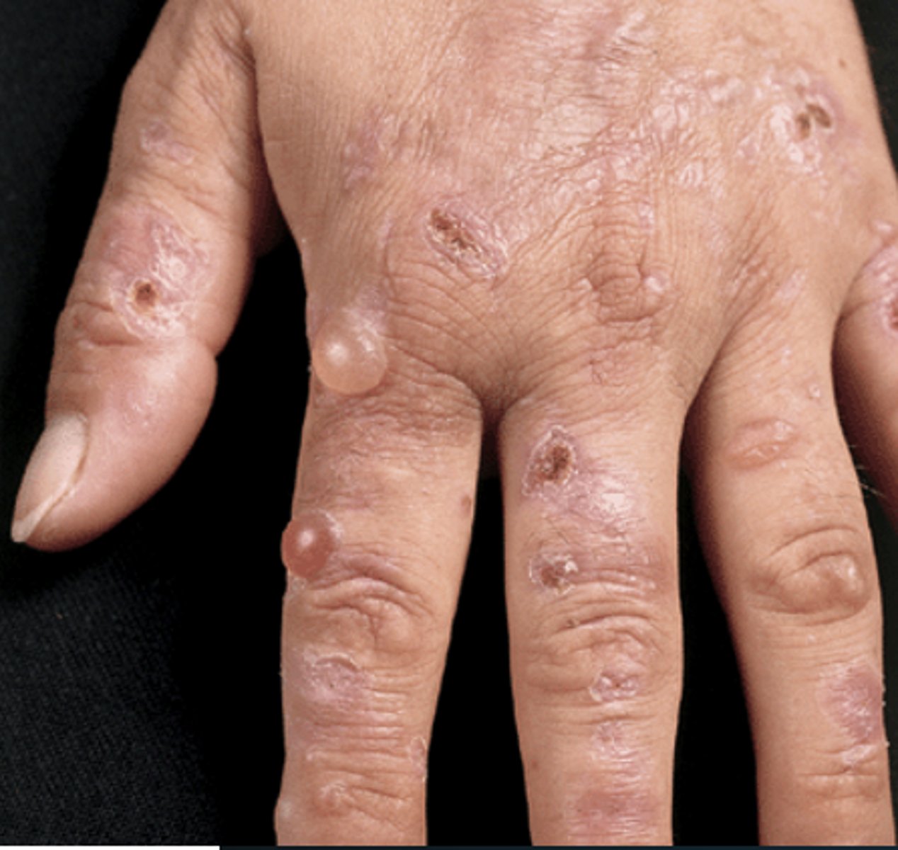 <p>Vesicles and bulla in dorsa of hands, scarring and small milia, hypertrichosis, mottled pigmentation</p>