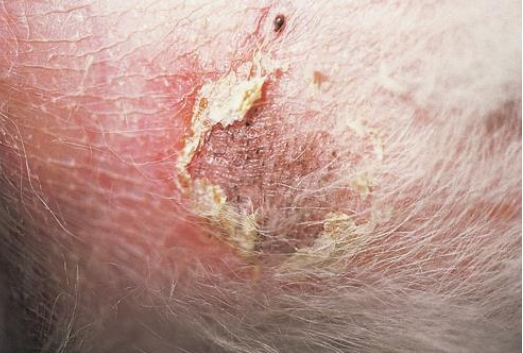 <ul><li><p><strong>secondary lesion</strong></p></li><li><p>flat to minimally elevated ring of scale that enlarges peripherally</p></li><li><p>remnant of an old pustule</p></li><li><p>ex. bacterial &amp; fungal infections</p></li></ul><p></p>