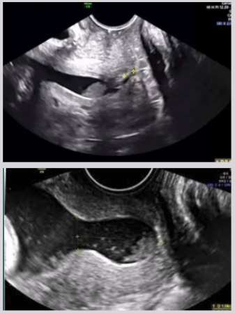 <ul><li><p><span style="background-color: transparent;">Occurs when 2+ clinical signs are present</span></p></li><li><p><span style="background-color: transparent;">Clinical signs:</span></p><ul><li><p><span style="background-color: transparent;">Effacement of CVX</span></p></li><li><p><span style="background-color: transparent;">Cervical dilation >3 cm</span></p></li><li><p><span style="background-color: transparent;">Rupture of membranes&nbsp;</span></p></li><li><p><span style="background-color: transparent;">Bleeding for >7 days</span></p></li><li><p><span style="background-color: transparent;">Persistent cramping</span></p></li></ul></li><li><p>US findings:</p><ul><li><p><span style="background-color: transparent;">Gestational sac seen in CVX or LUS</span></p></li><li><p><span style="background-color: transparent;">Cervical dilatation</span></p></li><li><p><span style="background-color: transparent;">Sonolucent crescent around gestational sac</span></p></li></ul></li></ul><p></p>