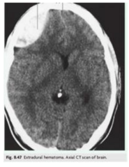 <p>A. Epidural hematoma</p>