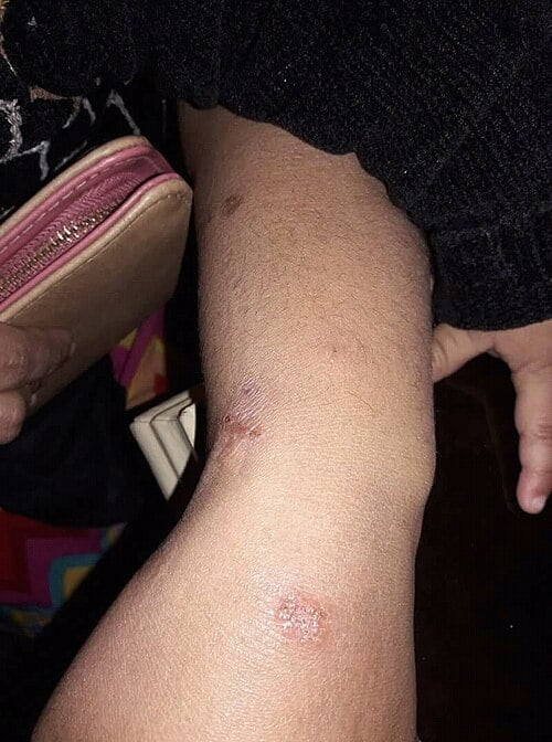 <p>Coin-shaped, oozing, crusted plaques that are intensely itchy </p><p>-Common on the lower legs, buttocks, and trunk </p><p>-Dx: clinical, KOH to rule out tinea corporis </p><p>-Tx: high or ultra high potency topical corticosteroids </p>