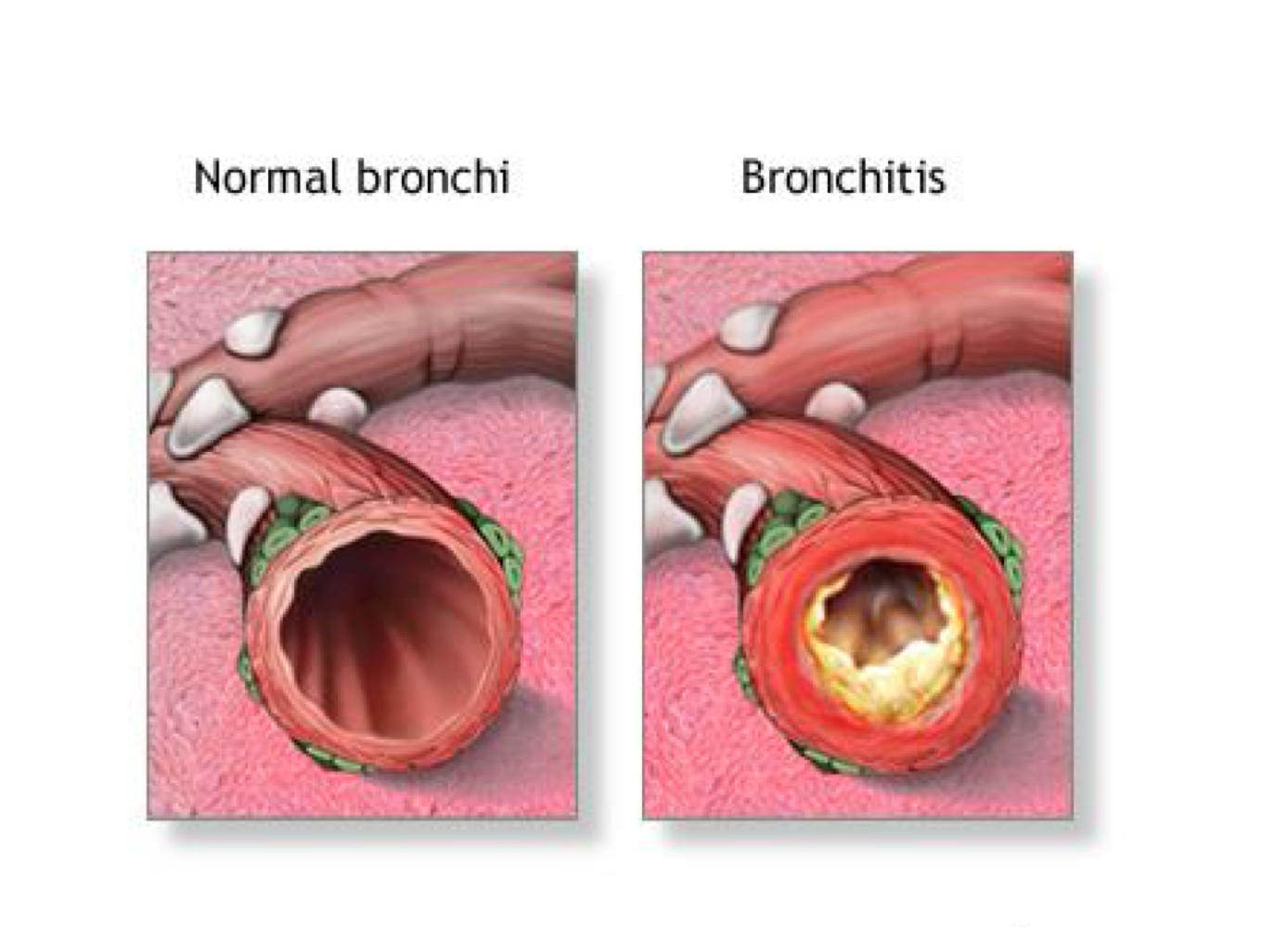 <p>Chronic bronchitis patho</p>