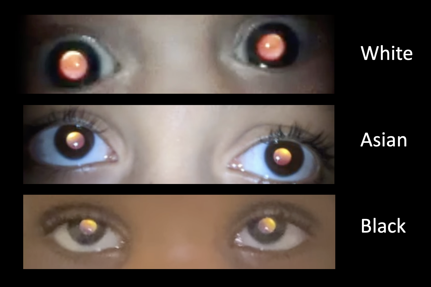 <p>red glow that appears to fill persons pupil with ophthalmoscope</p>