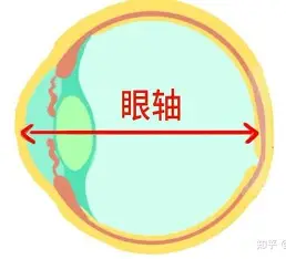 <p>眼轴伸长：长时间玩手机可能导致眼轴伸长。</p>