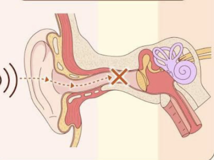 <p>Conductive hearing loss</p>