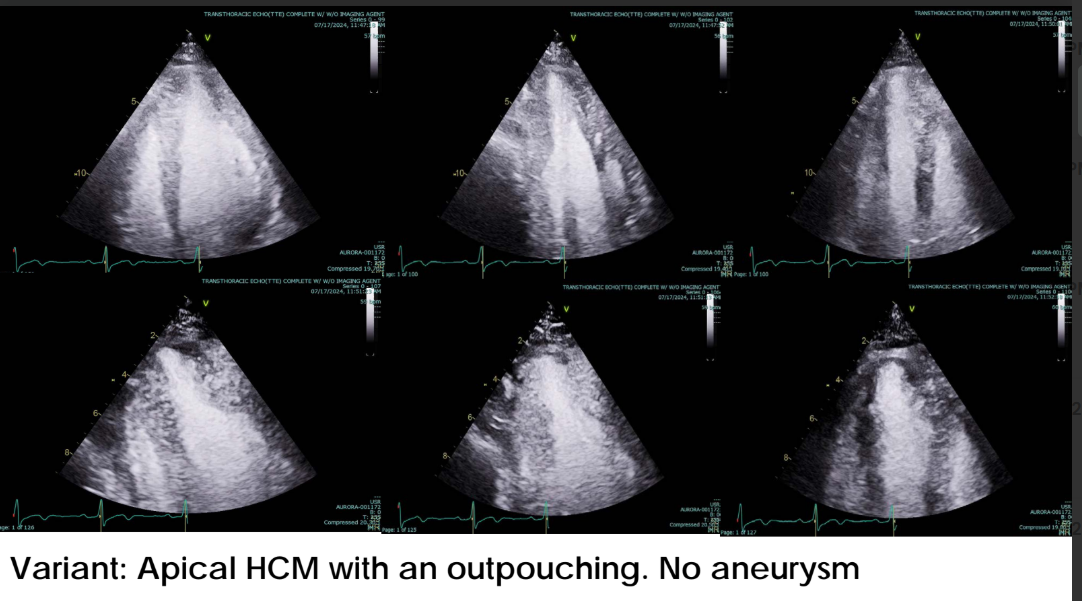 <p>Apical outpouching is a <strong>persistent apical cavity dimension at end-systole</strong> that is <strong>greater than the midventricular cavity dimension at end-systole</strong>.</p><p><strong>Simple reminder:</strong><br>At end-systole, the apical cavity remains larger than the midventricular cavity</p>
