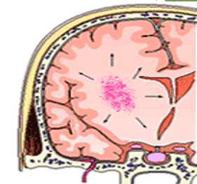 <p><span style="font-family: "Wingdings 3";">u</span><span style="font-family: "Trebuchet MS";">Severe contusion, laceration or penetrating injury</span></p><p><span style="font-family: "Wingdings 3";">u</span><span style="font-family: "Trebuchet MS";">Focal</span></p><p><span style="font-family: "Wingdings 3";">u</span><span style="font-family: "Trebuchet MS";">May present as coup-contre coup</span></p><p><span style="font-family: "Wingdings 3";">u</span><span style="font-family: "Trebuchet MS";">Suborbital, anterior temporal lobe</span></p><p><span style="font-family: "Wingdings 3";">u</span><span style="font-family: "Trebuchet MS";">Blood pools in white matter of brain.</span></p><p><span style="font-family: "Wingdings 3";">u</span><span style="font-family: "Trebuchet MS";">Brain trauma can cause several severe IPHs, and can result in white matter shear injury—extensive loss of axons w/extensive brain injury.</span></p><p><span style="font-family: "Wingdings 3";">u</span><span style="font-family: "Trebuchet MS";">This can cause diffuse axonal injury.</span></p>