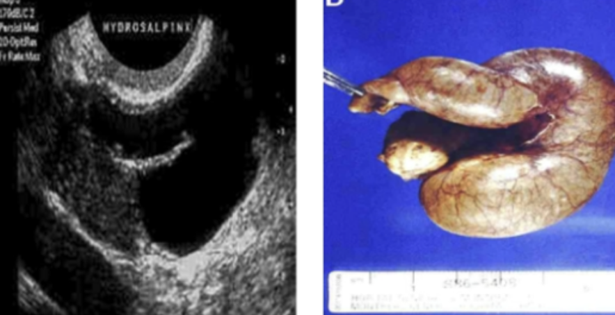 <p>⚠️‼️(#39,#49,#51)44.Identify the lesion: A.Hydrosalpinx B.Tobacco pouching C.Endometritis D.Fitz-Hugh Curtis Syndrome</p>