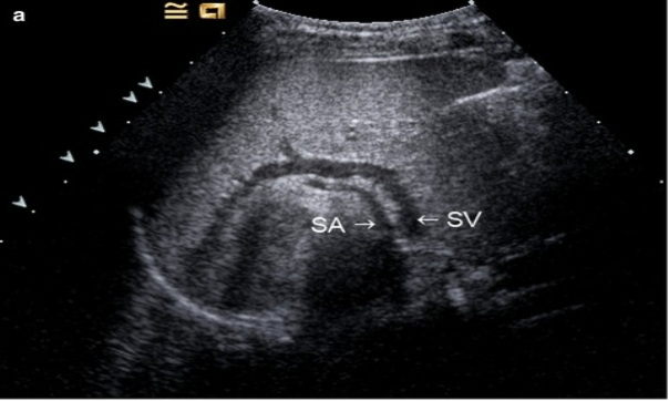 <p>Splenic artery </p>