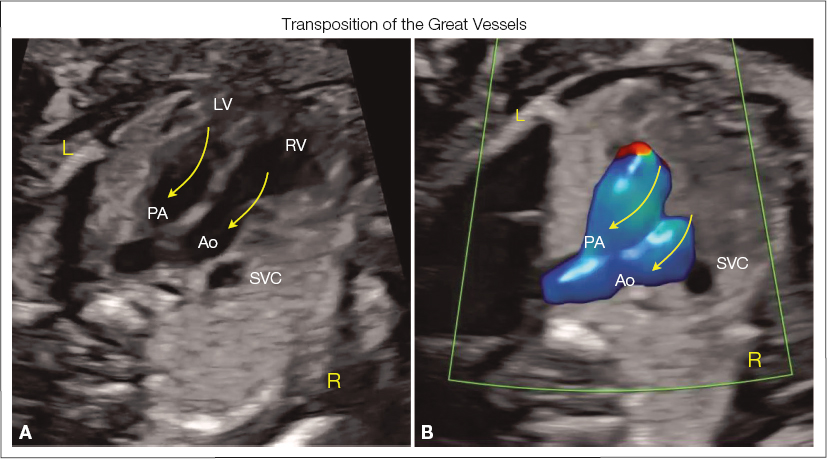 <p>The pulmonary artery abnormally arises from the left ventricle, and the aorta abnormally arises from the right ventricle</p><p>The outflow tracts will be positioned parallel to each other rather than crisscrossing</p><p>VSD may be present</p>