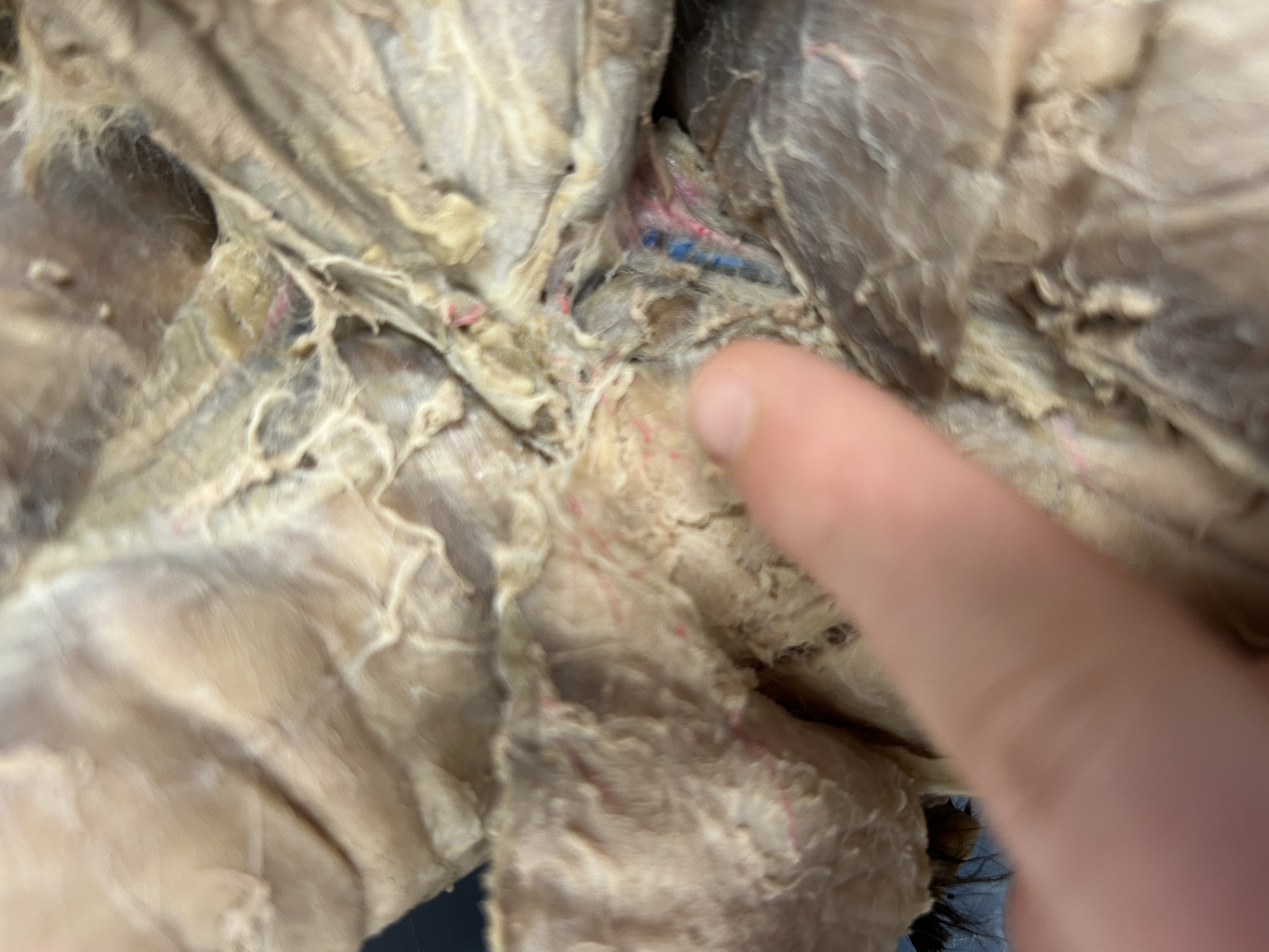 <p>Adductor Longus (space with nerves)</p>